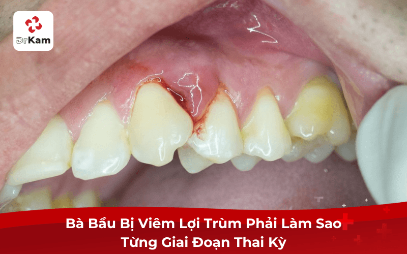 Bà Bầu Bị Viêm Lợi Trùm Phải Làm Sao Từng Giai Đoạn Thai Kỳ