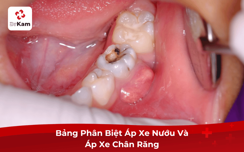 Bảng Phân Biệt Áp Xe Nướu Và Áp Xe Chân Răng