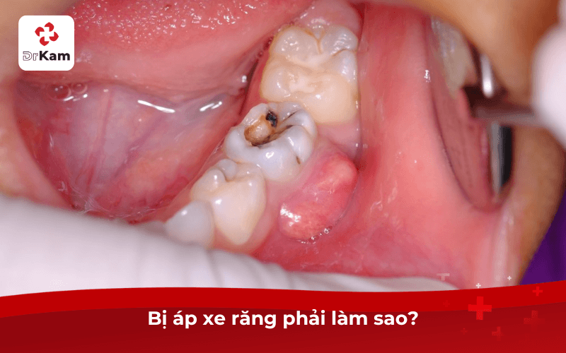 Bị áp xe răng phải làm sao?