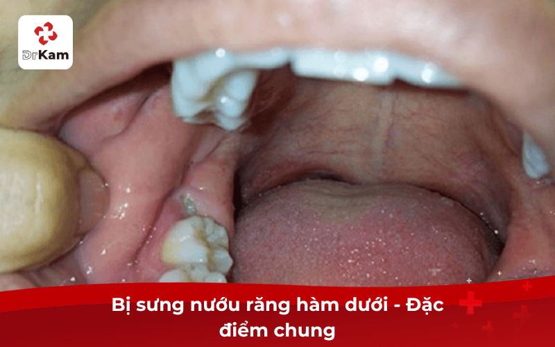 Bị Sưng Nướu Răng Trong Cùng Hàm Dưới — 5 Nguyên Nhân Phổ Biến