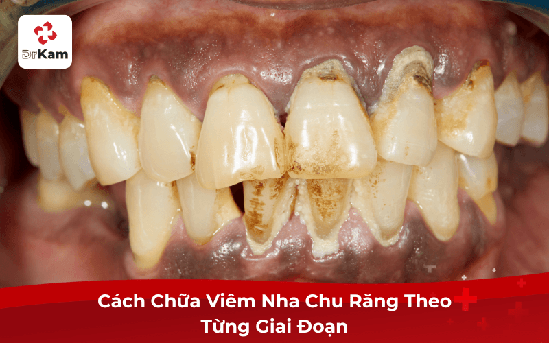 Cách Chữa Viêm Nha Chu Răng Theo Từng Giai Đoạn