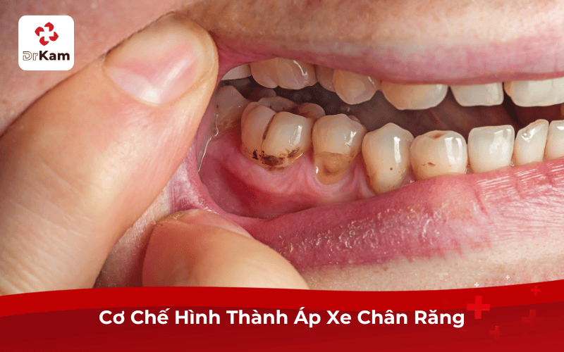 Cơ Chế Hình Thành Áp Xe Chân Răng