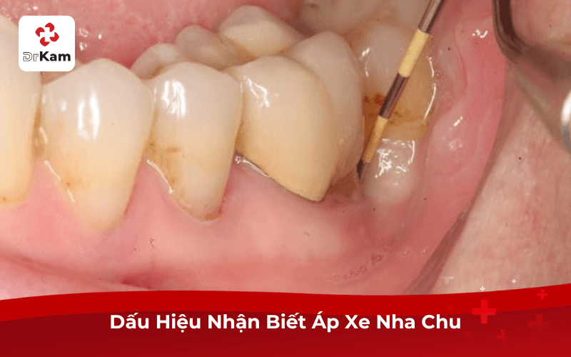 Dấu Hiệu Nhận Biết Áp Xe Nha Chu