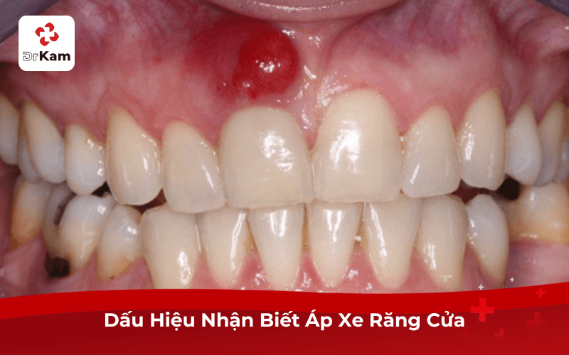 Dấu Hiệu Nhận Biết Áp Xe Răng Cửa