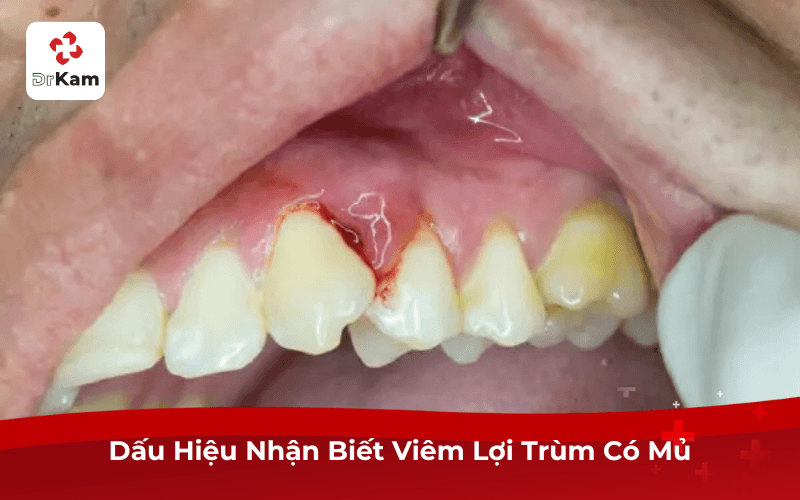 Dấu Hiệu Nhận Biết Viêm Lợi Trùm Có Mủ