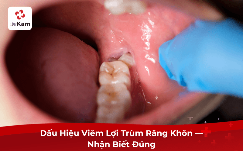 Dấu Hiệu Viêm Lợi Trùm Răng Khôn