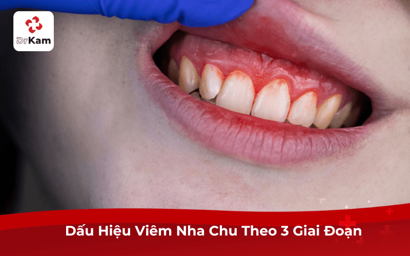 Dấu Hiệu Viêm Nha Chu Theo 3 Giai Đoạn