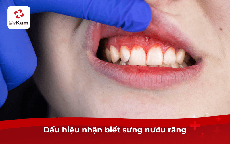 Dấu Hiệu Nhận Biết Sưng Nướu Răng