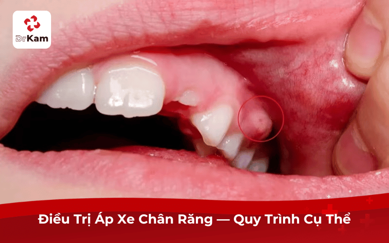 Điều Trị Áp Xe Chân Răng — Quy Trình Cụ Thể