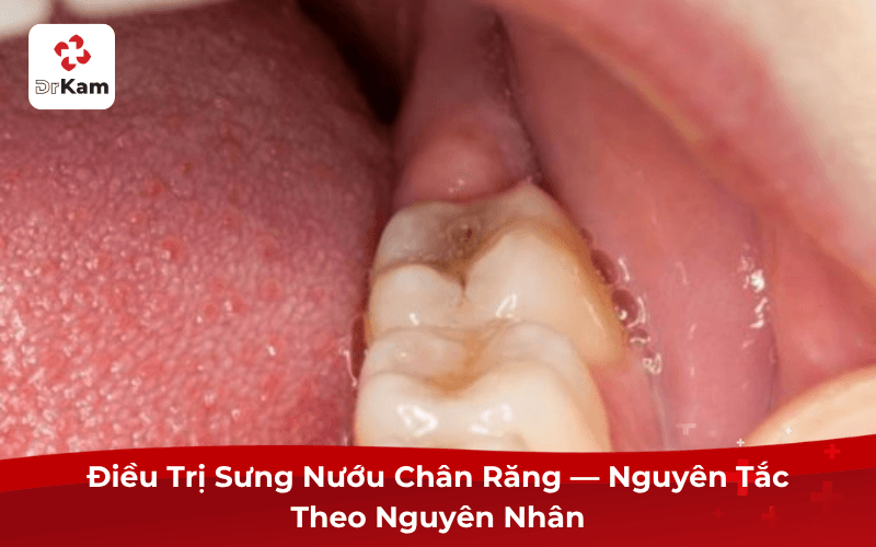 Điều Trị Sưng Nướu Chân Răng