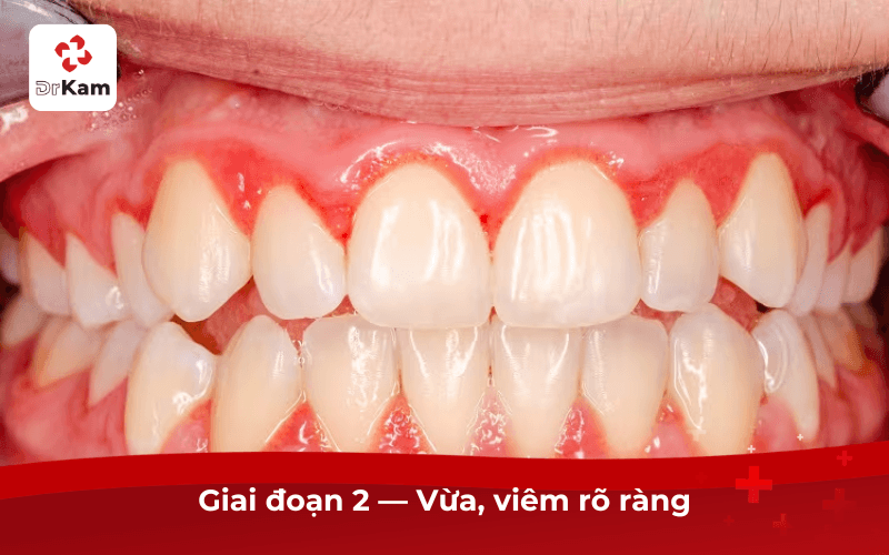 Hình ảnh viêm nướu răng giai đoạn 2