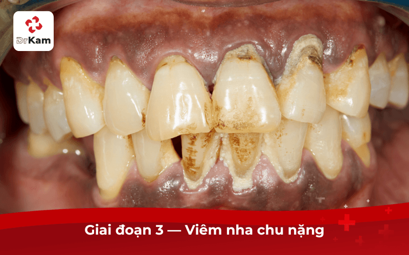 Giai đoạn 3 — Viêm nha chu nặng