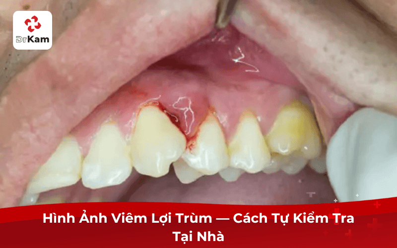 Hình Ảnh Viêm Lợi Trùm — Cách Tự Kiểm Tra Tại Nhà