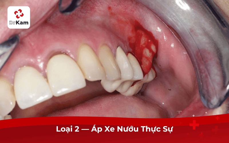 Loại 2 — Áp Xe Nướu Thực Sự