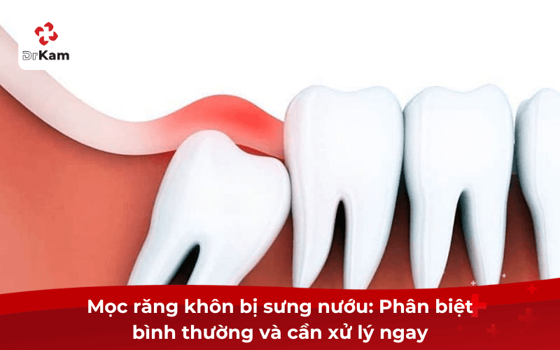 Sưng nướu răng khôn phân biệt