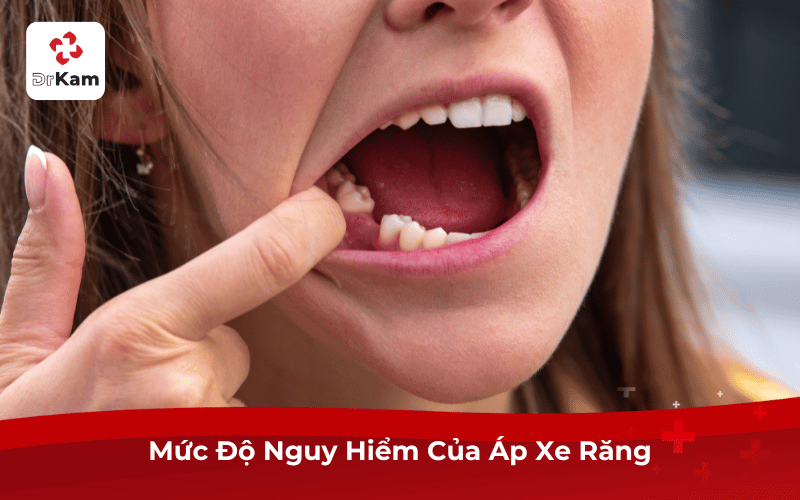 Mức Độ Nguy Hiểm Của Áp Xe Răng