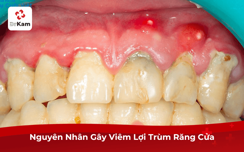 Nguyên Nhân Gây Viêm Lợi Trùm Răng Cửa