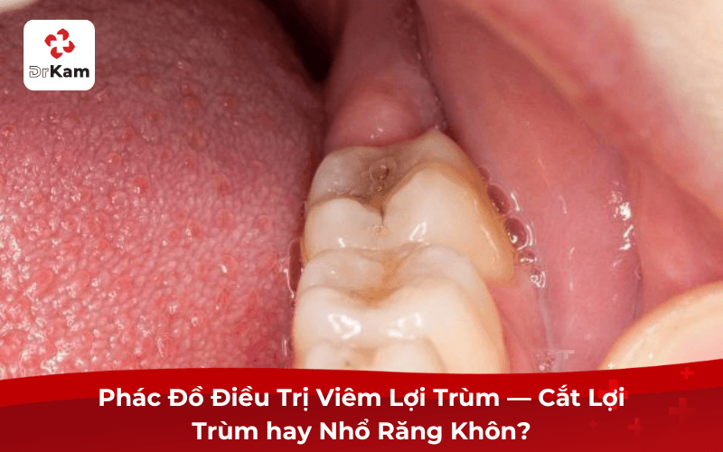 Phác Đồ Điều Trị Viêm Lợi Trùm