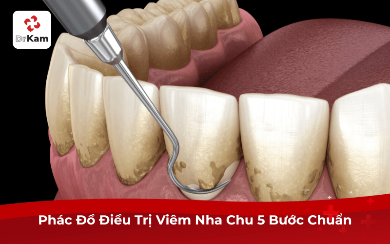 Phác Đồ Điều Trị Viêm Nha Chu 5 Bước Chuẩn