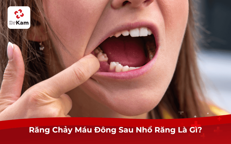 Răng Chảy Máu Đông Sau Nhổ Răng Là Gì?