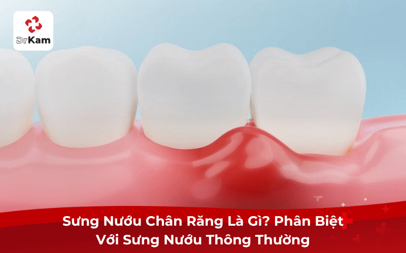 Sưng Nướu Chân Răng Là Gì?