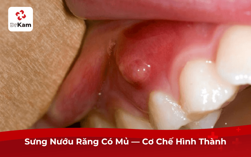Sưng Nướu Răng Có Mủ — Cơ Chế Hình Thành