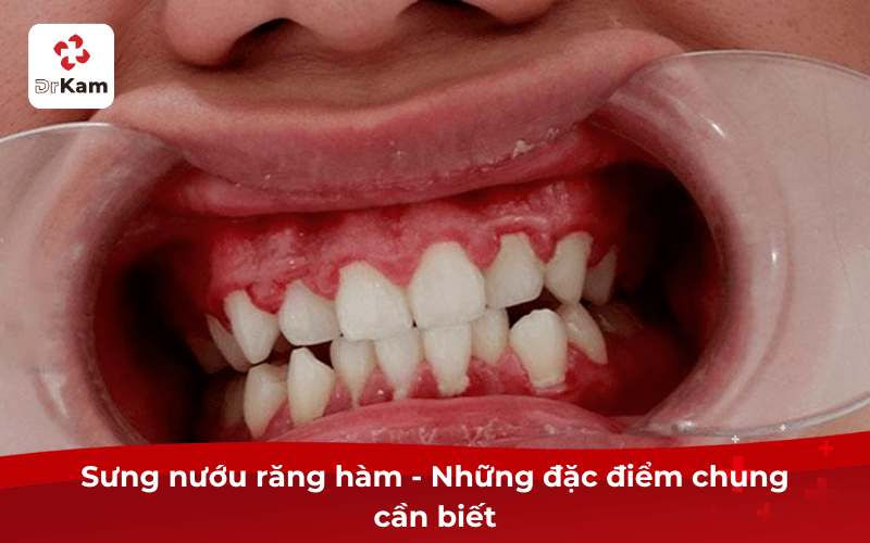 Sưng Nướu Răng Hàm — Những Đặc Điểm Chung Cần Biết