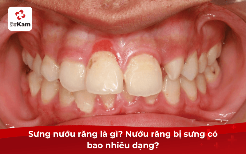 Sưng Nướu Răng Là Gì? Nướu Răng Bị Sưng Có Bao Nhiêu Dạng?
