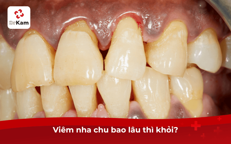 Viêm nha chu bao lâu thì khỏi? Bảng Thời Gian Điều Trị 