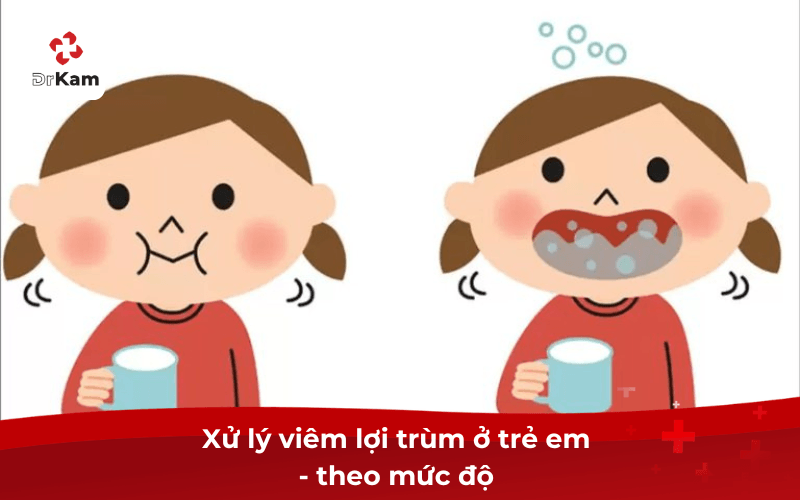 Xử Lý Viêm Lợi Trùm Ở Trẻ Em