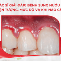 [Bác sĩ giải đáp] Bệnh sưng nướu răng: Hiện tượng, mức độ và khi nào cần lo