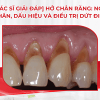 [Bác sĩ giải đáp] Hở chân răng: Nguyên nhân, dấu hiệu và điều trị dứt điểm