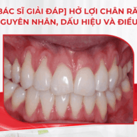 [Bác sĩ giải đáp] Hở lợi chân răng: Nguyên nhân, dấu hiệu và điều trị