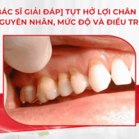 [Bác sĩ giải đáp] Tụt hở lợi chân răng: Nguyên nhân, mức độ và điều trị