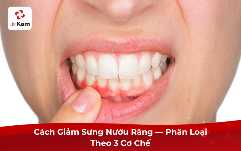 Cách Giảm Sưng Nướu Răng — Phân Loại Theo 3 Cơ Chế