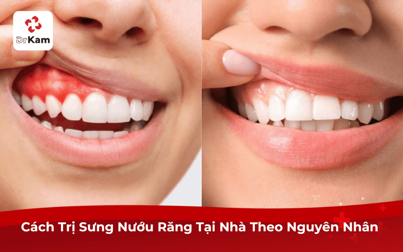 Cách Trị Sưng Nướu Răng Tại Nhà