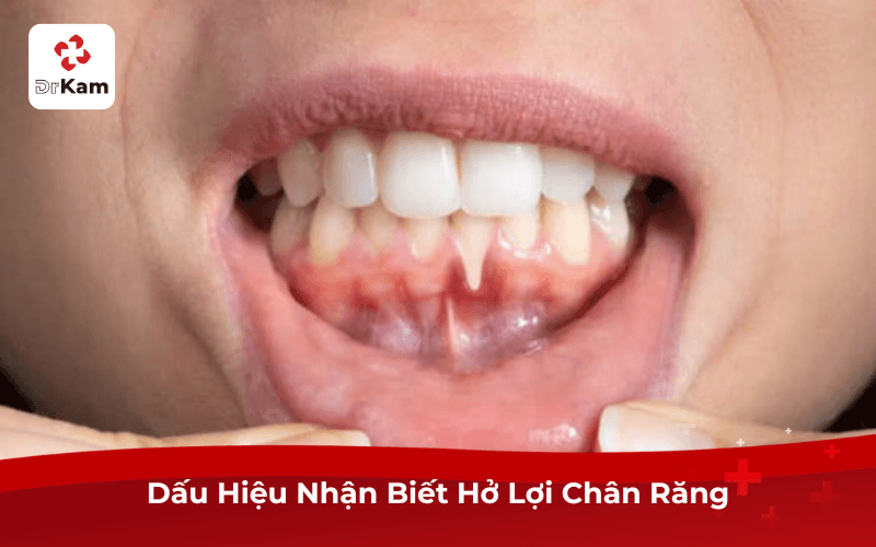 Dấu Hiệu Nhận Biết Hở Lợi Chân Răng