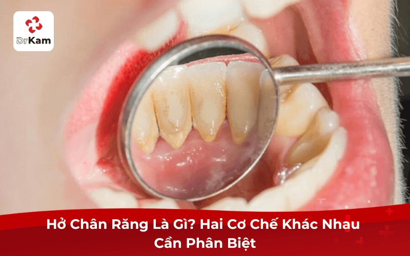 Hở Chân Răng Là Gì?