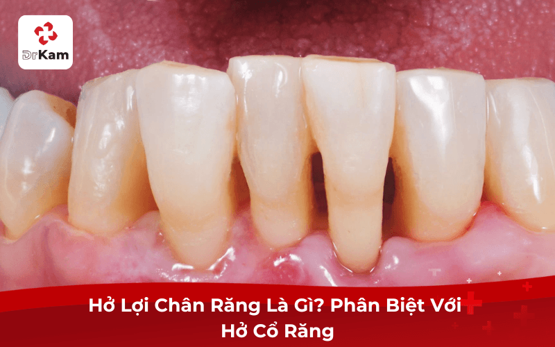 Hở Lợi Chân Răng Là Gì? Phân Biệt Với Hở Cổ Răng