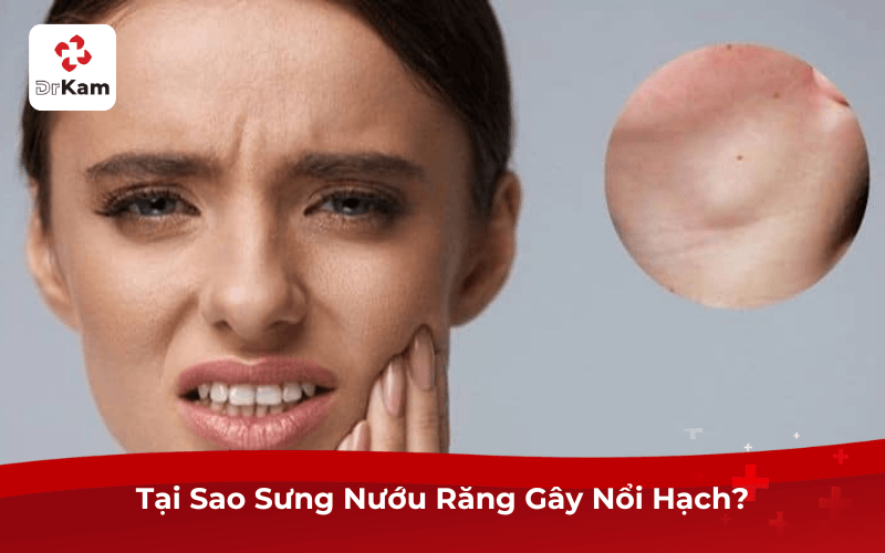 Tại Sao Sưng Nướu Răng Gây Nổi Hạch?