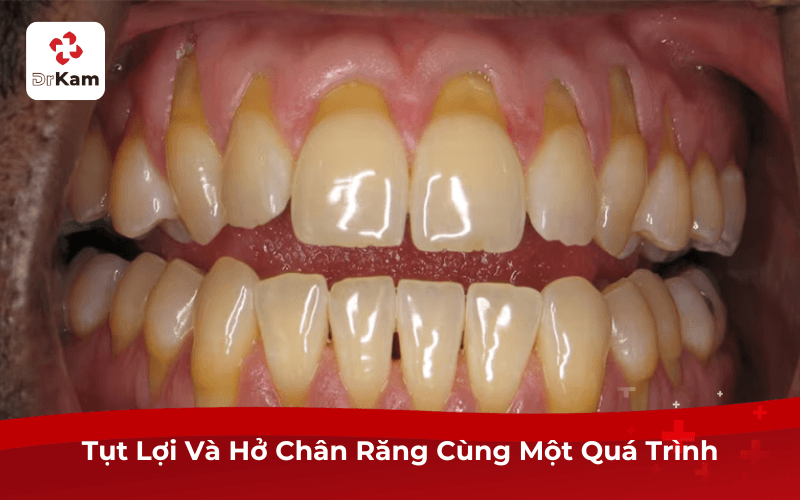 Tụt Lợi Và Hở Chân Răng Cùng Một Quá Trình