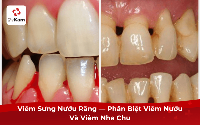 Viêm Sưng Nướu Răng — Phân Biệt Viêm Nướu Và Viêm Nha Chu